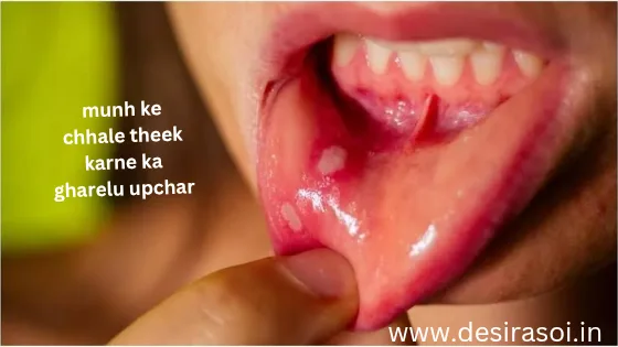 मुंह के छाले ठीक करने के लिए कुछ महत्वपूर्ण घरेलू टिप्स 4 मुंह के छाले ठीक करने के लिए कुछ महत्वपूर्ण घरेलू टिप्स 2